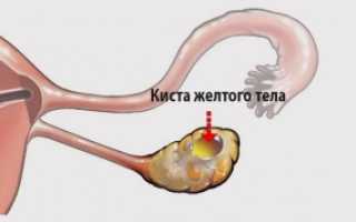 Признаки кисты желтого тела правого яичника и методы лечения новообразования