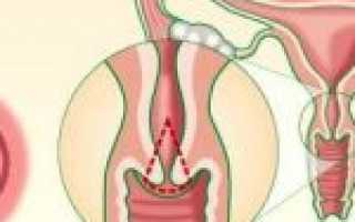 Дисплазия шейки матки 3 степени