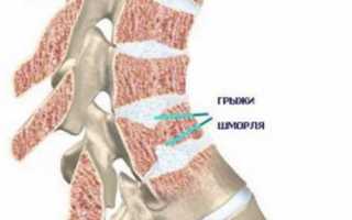 Грыжа Шморля поясничного отдела позвоночника