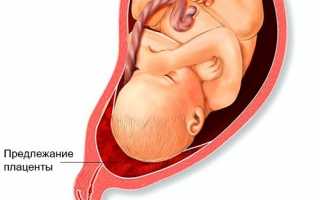 Артрит коленного сустава: симптомы и лечение