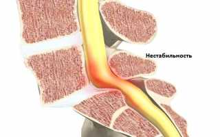 Нестабильность шейного отдела позвоночника симптомы и лечение