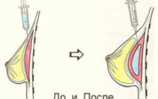 Как быстро увеличить размер груди без пластики?