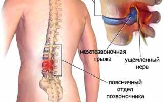 Лечебная гимнастика при грыже поясничного отдела позвоночника