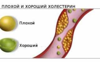 Что такое “плохой” и “хороший” холестерин в крови?