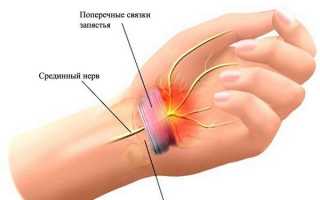 Симптомы и лечение синдрома запястного канала