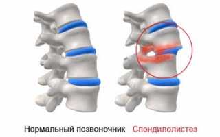 Спондилолистез пояснично-крестцового отдела позвоночника