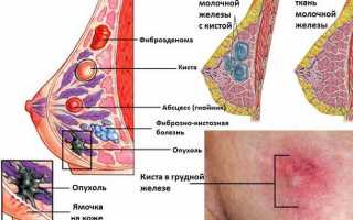 Опасность кисты в грудных железах