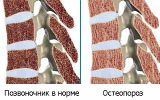 Остеопороз позвоночника: симптомы и лечение