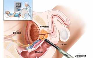 Все самое важное о трансректальном УЗИ (ТРУЗИ) простаты