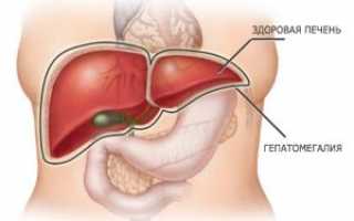 Основные симптомы гепатомегалии печени