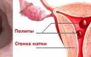 Удаление полипа эндометрия: как проводится лечение