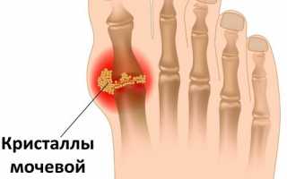 Лечение подагры, симптомы