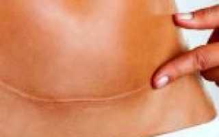 Спаечный процесс брюшной полости