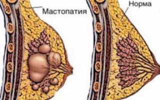 О чем свидетельствуют выделения из грудных желез при надавливании?