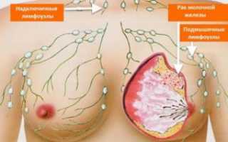 От первых признаках до метастазирования рака молочной железы