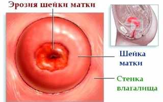 Лечение эрозии шейки матки