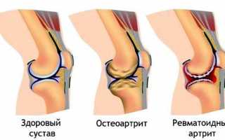 Болят колени: что делать?