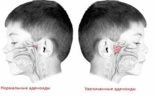 Аденоиды 1, 2 и 3 степени у детей