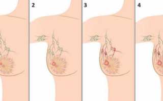 Как распознать рак молочной железы и что делать?