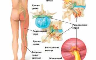 Симптомы люмбаго и его лечение в домашних условиях