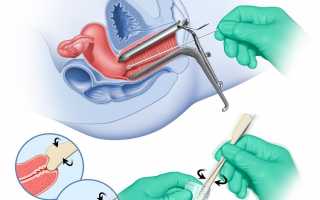 Мазок на онкоцитологию – что это, когда сдавать, расшифровка