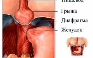 Радикулит поясничный: симптомы и медикаментозное лечение