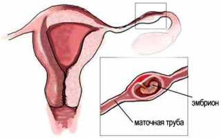 Первые признаки внематочной беременности