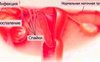 Признаки и методы лечения непроходимости маточных труб