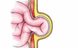 Пупочная грыжа у взрослых